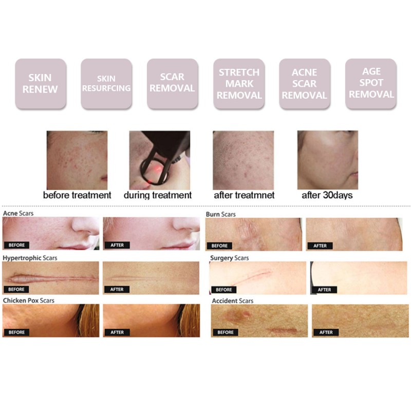 Clinic-Grade CO2 Laser Manufacturer - 2000W 3000W Skin Rejuvenation