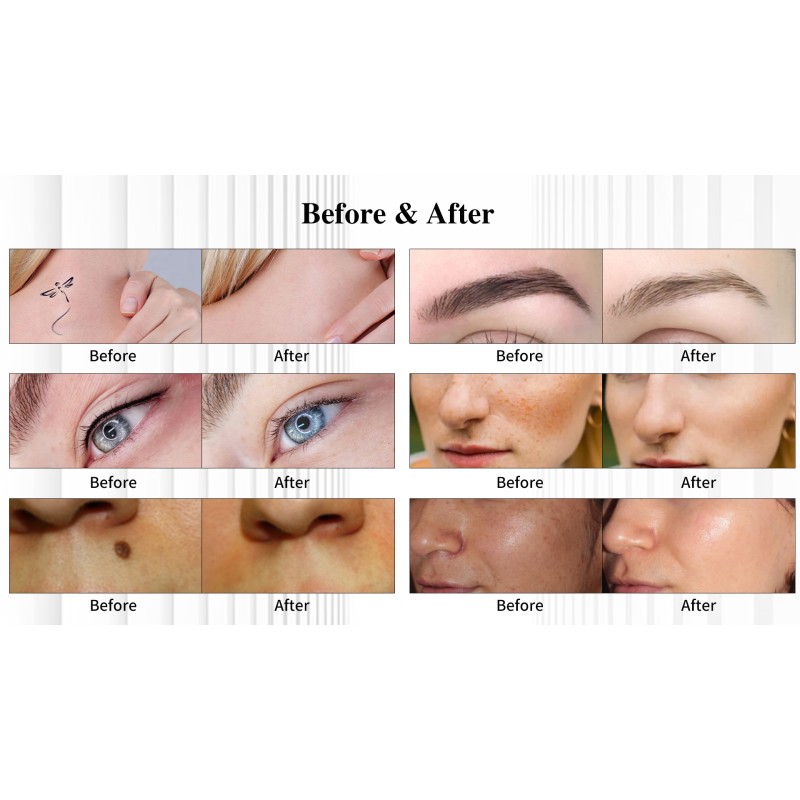 Picosecond Laser Pen Machine Factory - Tattoo Pigment Removal