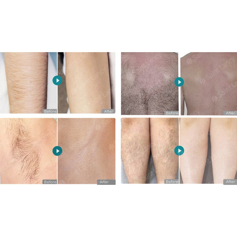 Triple Wavelength Diode Laser Supplier - Portable HIFU IPL