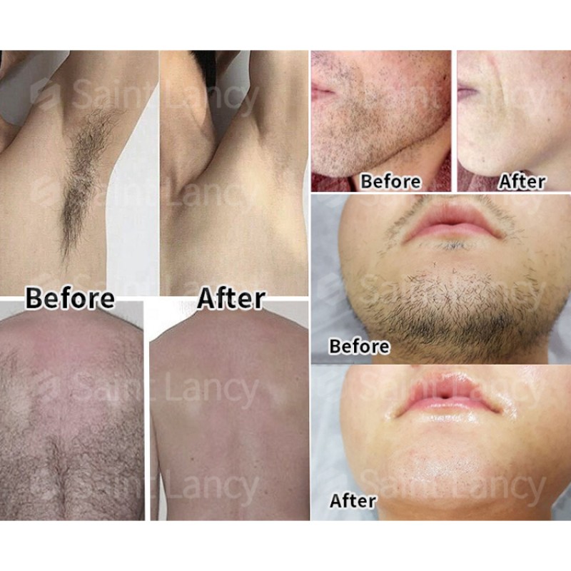 Portable 808 Diode Laser Supplier - 755 808 1064nm Hair Removal