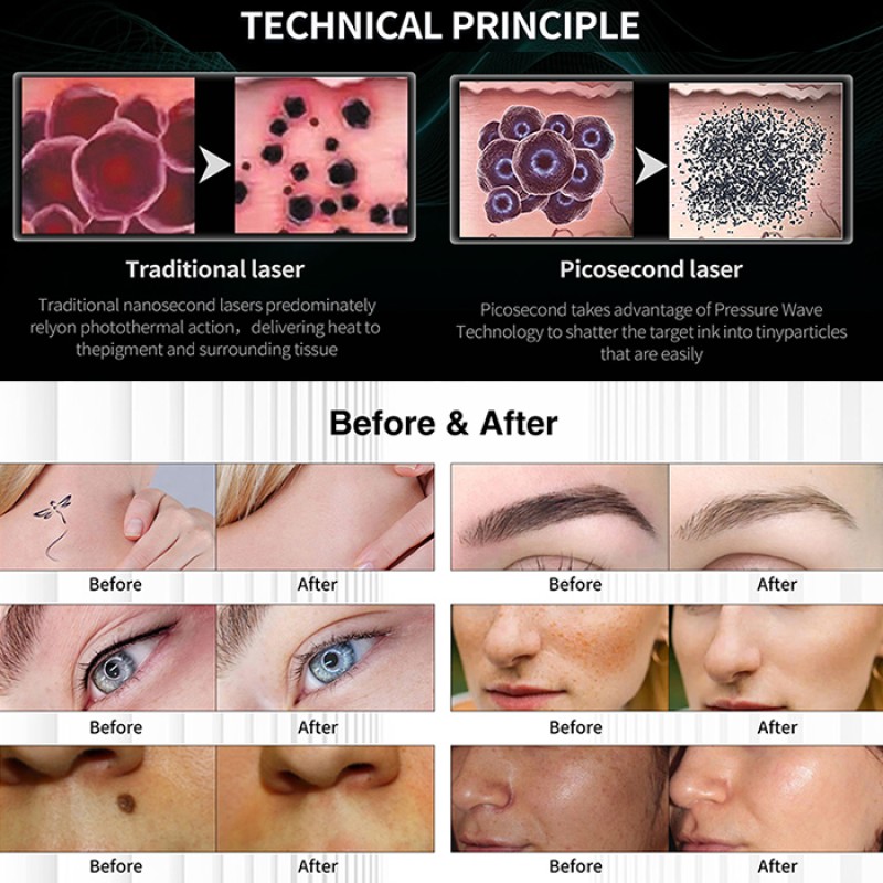 Nd Yag Laser Skin Machine Factory - Face Lips Eyes Multi Plug