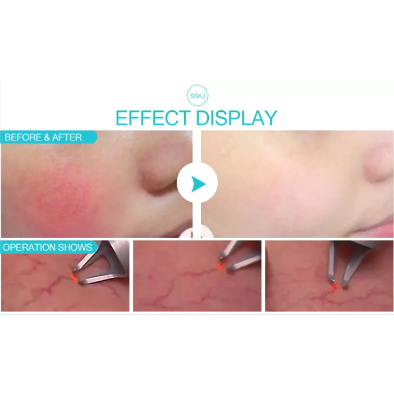 ODM Portable Diode Laser Manufacturer - 980 nm Spider Vein