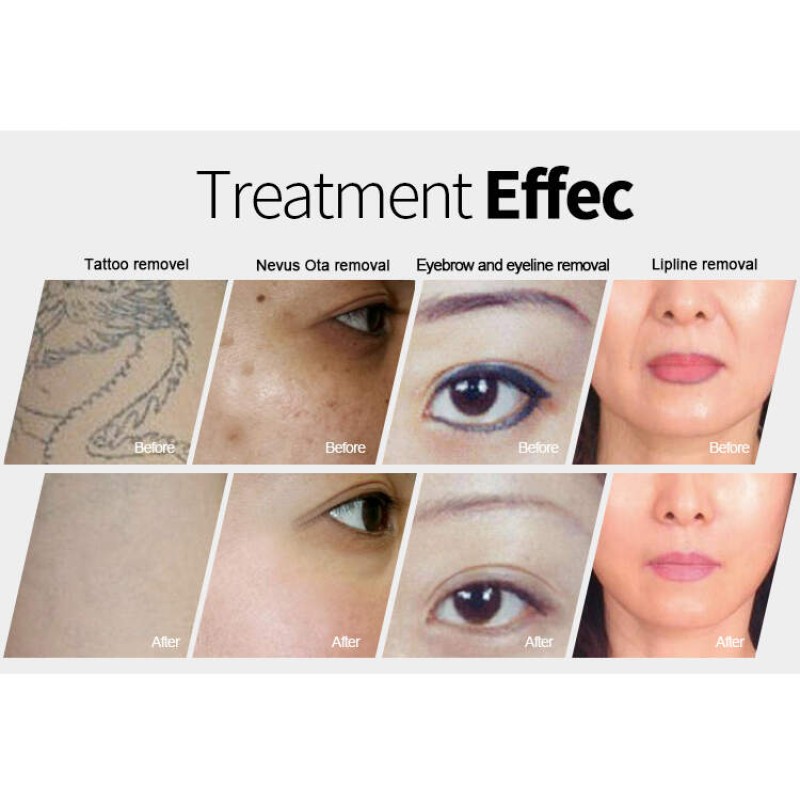 Picosecond High Power Laser Machine Manufacturer - Portable Nd Yag