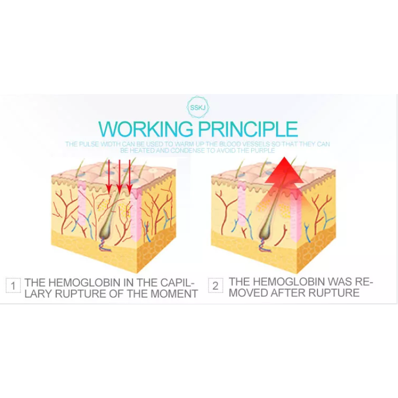 Portable Medical Diode Laser Machine Factory - 980nm Spider Vein