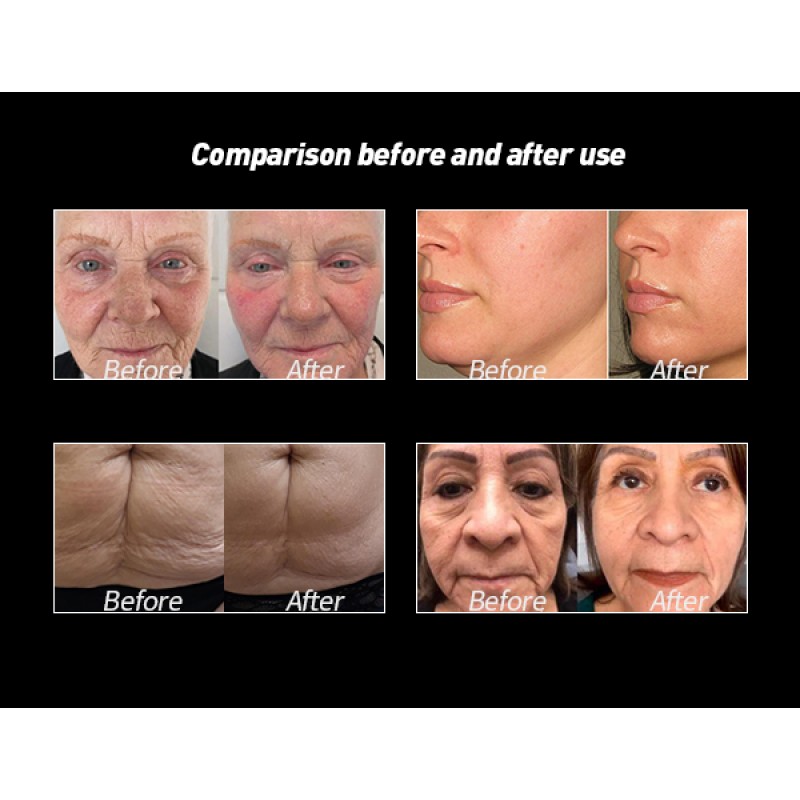 7D 9D 11D HIFU Machine Manufacturer - Vaginal Face Lift Multi Plug