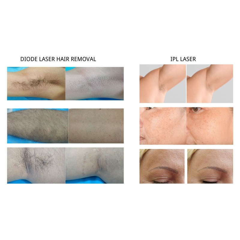 High Frequency Diode Laser Machine Factory - 980nm Spider Vein