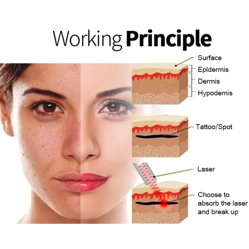 Portable ND YAG Laser Machine Factory - Q Switch Picosecond Best