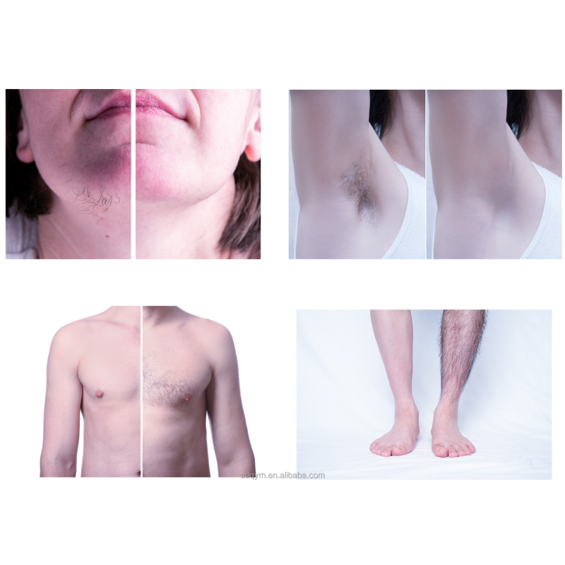 Diode Laser Hair Removal Machine Manufacturer - 4 Waves 755 808 1064nm