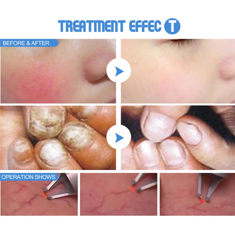 980 nm Diode Laser Beauty Equipment Factory - Spider Vein Removal