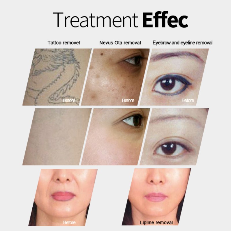 Triple Wavelength Diode Laser Supplier - Portable HIFU IPL