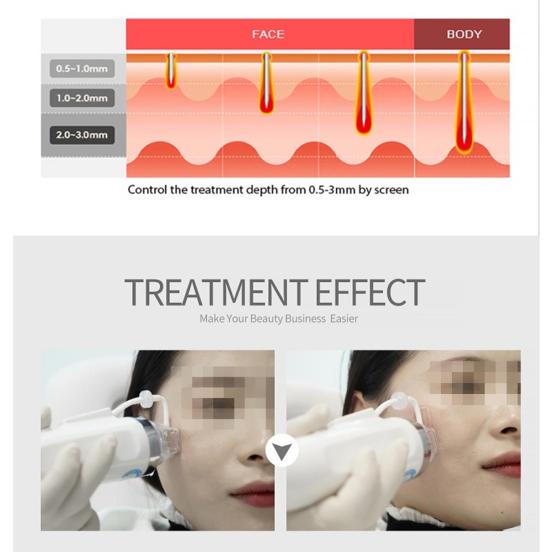 Salon Laser Spider Veins Machine Manufacturer - 980nm Nail Fungus