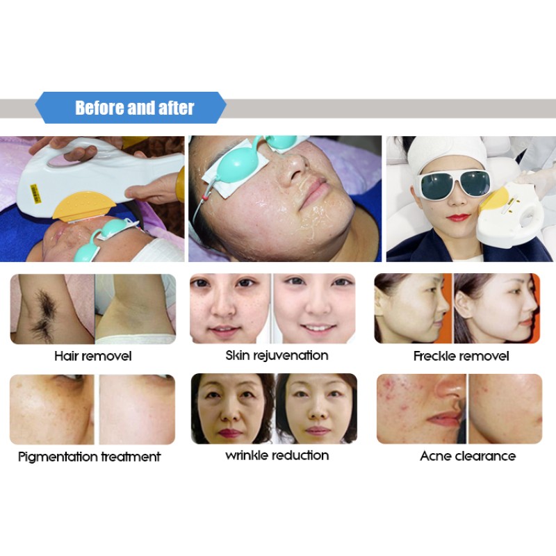 Triple Wavelength Diode Laser Supplier - Portable HIFU IPL