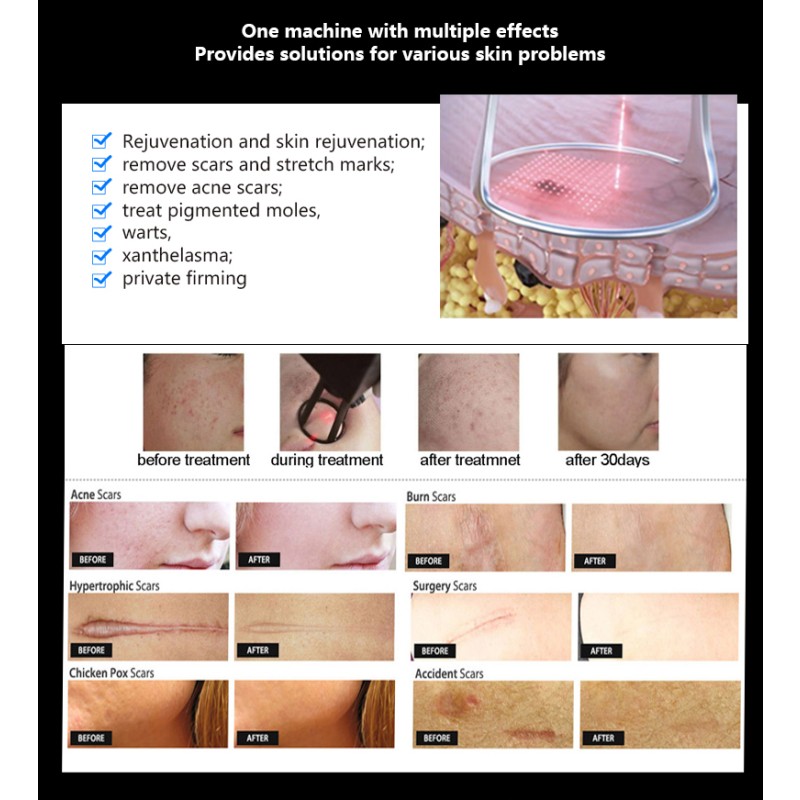 Professional CO2 Laser Machine Supplier - 3000W Fractional Skin