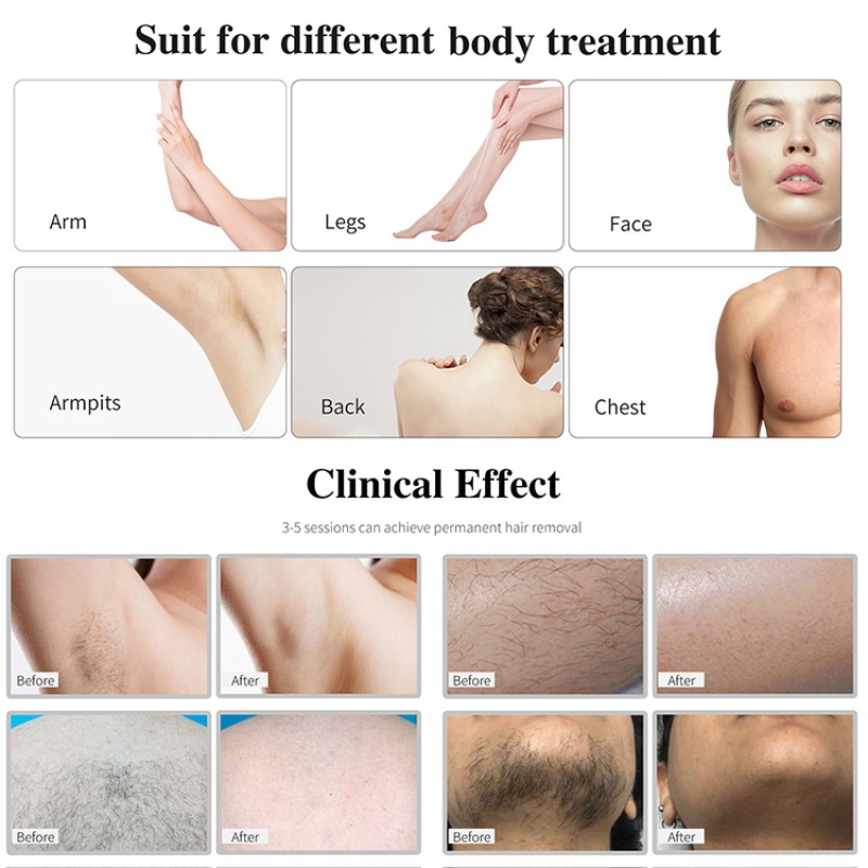 Aesthetic Medicine Laser Machine Manufacturer - 755 808 1064 Diode