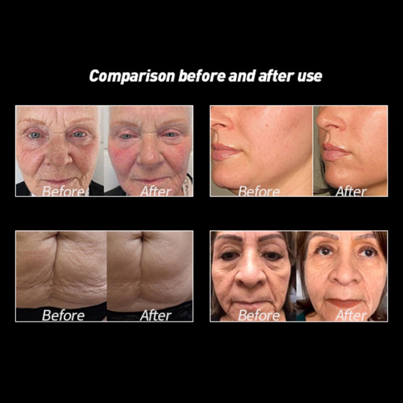 Portable HIFU Beauty Machine Supplier - Focused Tissue Revitalization