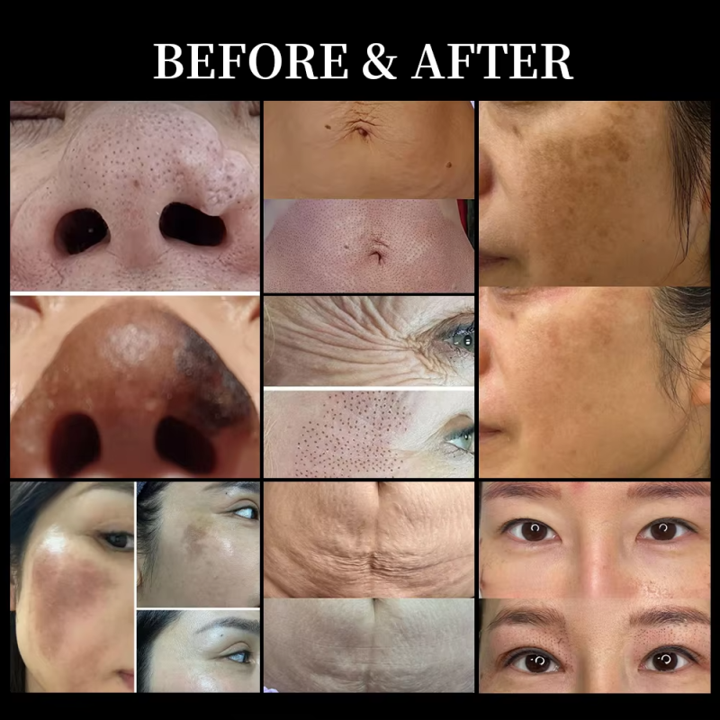 Cold Plasma Machine Supplier - OEM 2025 Skin Therapy Scar Acne Removal