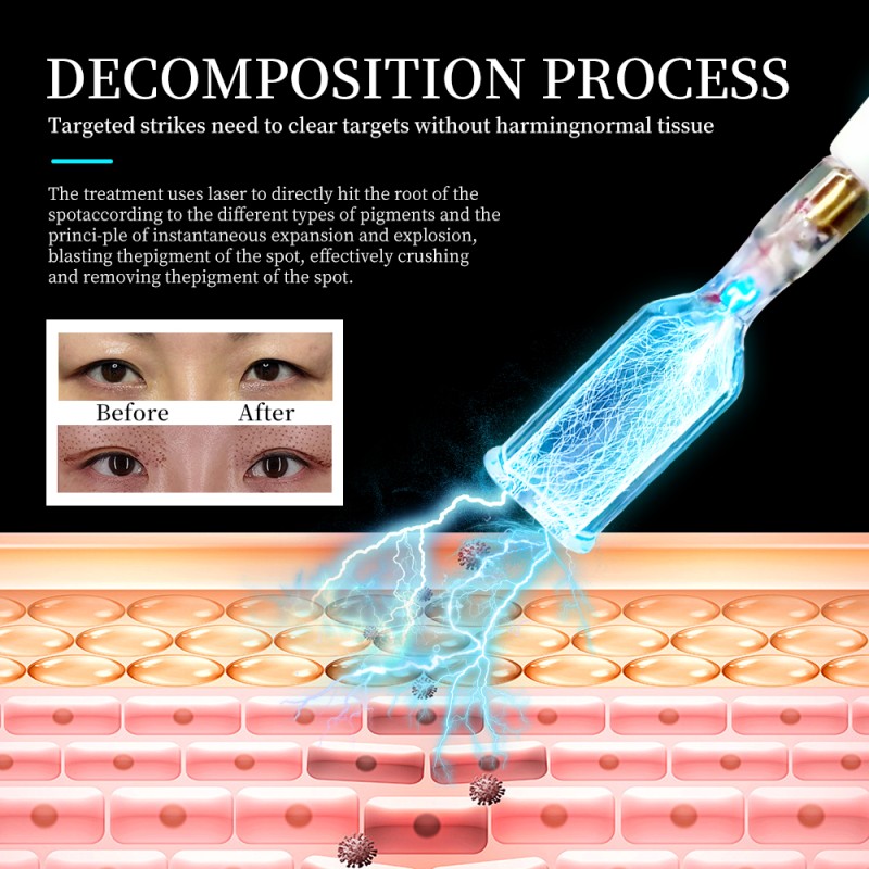 Portable Plasma Device Manufacturer - OEM Cold Plasma Care Acne Removal Instrument