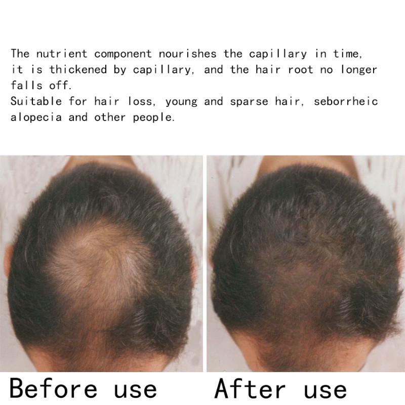 Hair Regrowth Serum Manufacturer - OEM Natural Keratin Anti Hair Loss Serum
