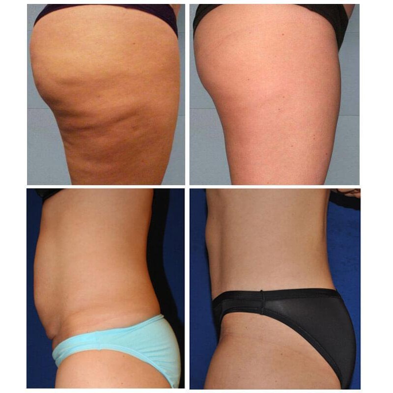 Body Tightening Cream Manufacturer - OEM Hot Sale Sculpt Firming Hot Gel