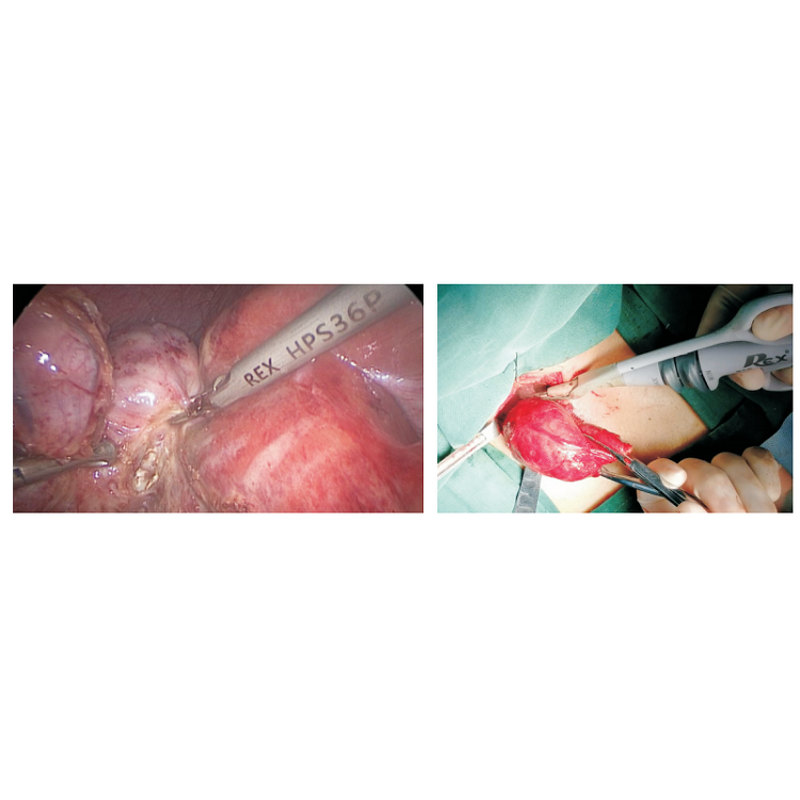 Ultrasound Scalpel System - Manufacturer - Surgical Cutting Hemostasis Medical