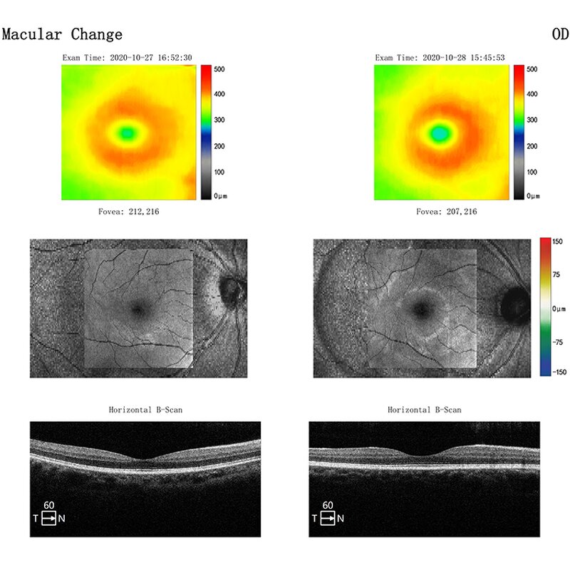 Handheld Slit Lamp - Manufacturer - Ophthalmic Portable Glare Test Equipment