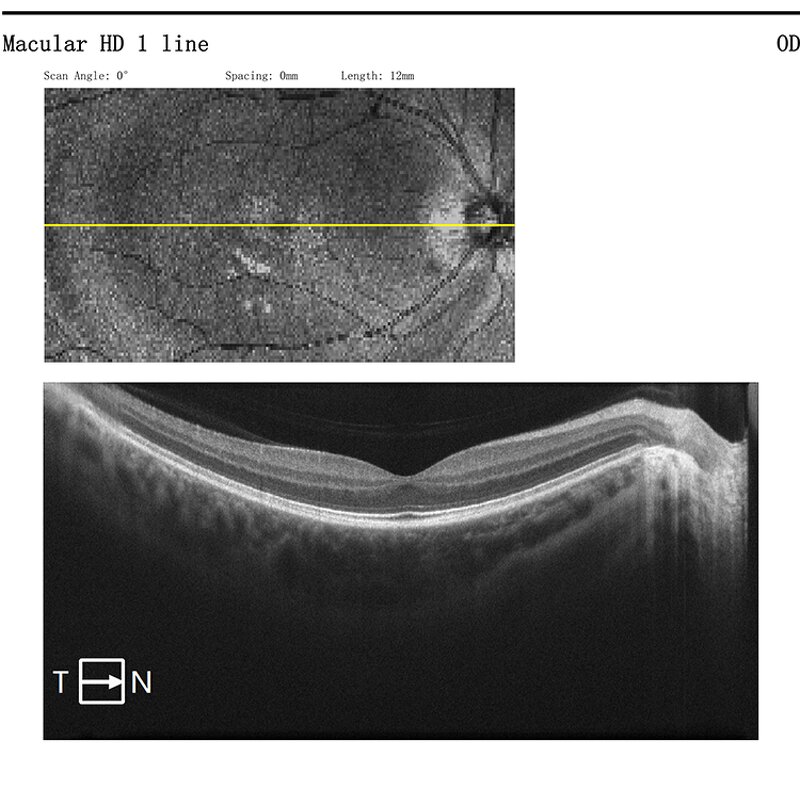 Handheld Slit Lamp - Manufacturer - Ophthalmic Portable Glare Test Equipment