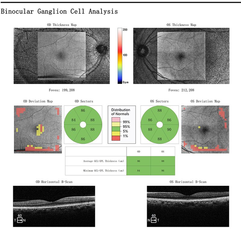 Handheld Slit Lamp - Manufacturer - Ophthalmic Portable Glare Test Equipment
