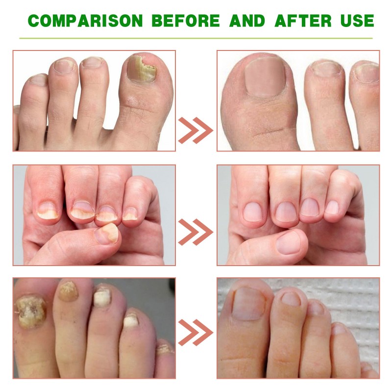 Herbal Nail Treatment Manufacturer - 7 Days Ginger Extract Liquid