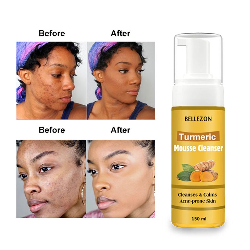 Turmeric Face Wash Manufacturer - Clearing Acne Scars Age Spots for Dark Spots