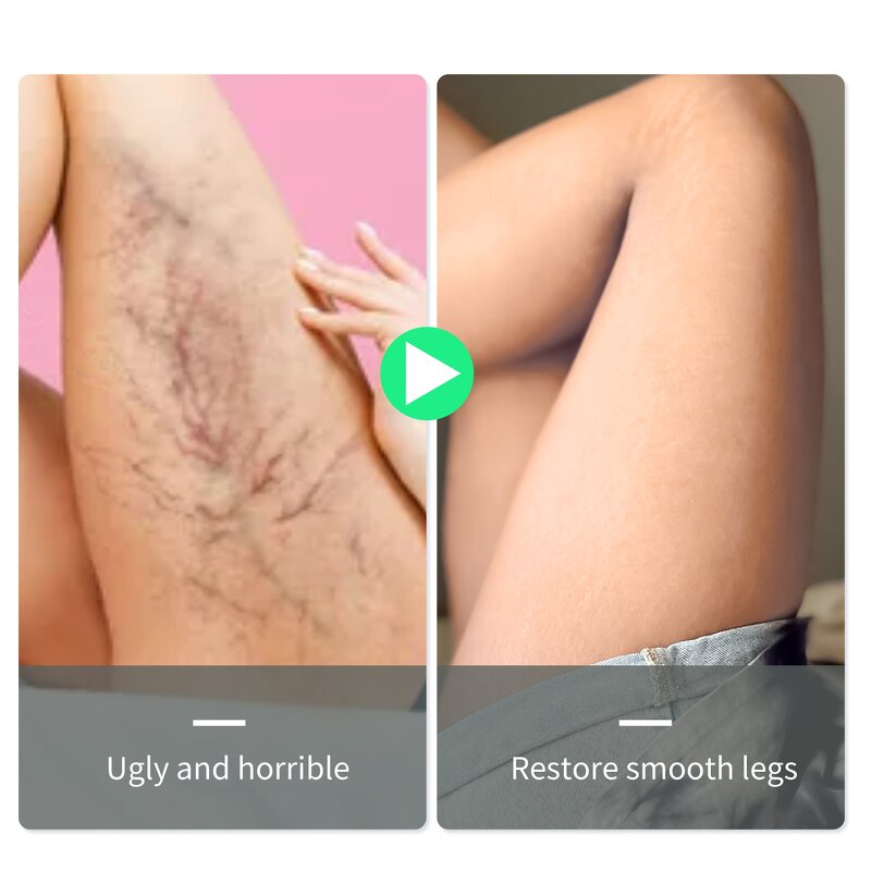 Varicose Veins Spray Manufacturer - Wholesale Hand & Foot Care Relief Spray