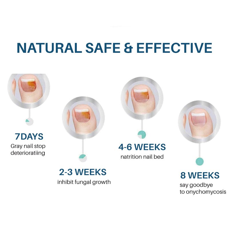 Nail Fungus Removal Gel Manufacturer - Feet Care for Toe Nail Fungus Anti Infection Paronychia Onychomycosis