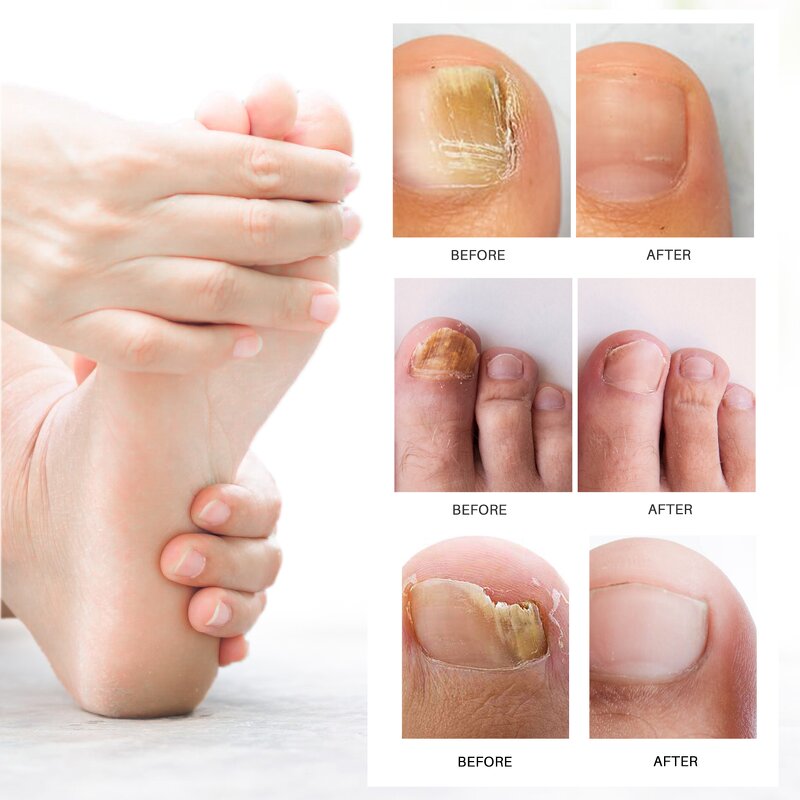 Nail Fungus Removal Cream Manufacturer - Lanthome Onychomycosis Fungal Treatment Paronychia Anti Infection Feet Toe Care