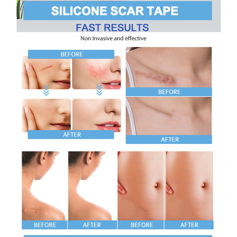 Scar Removal Strips Manufacturer - Professional Prevention Solution