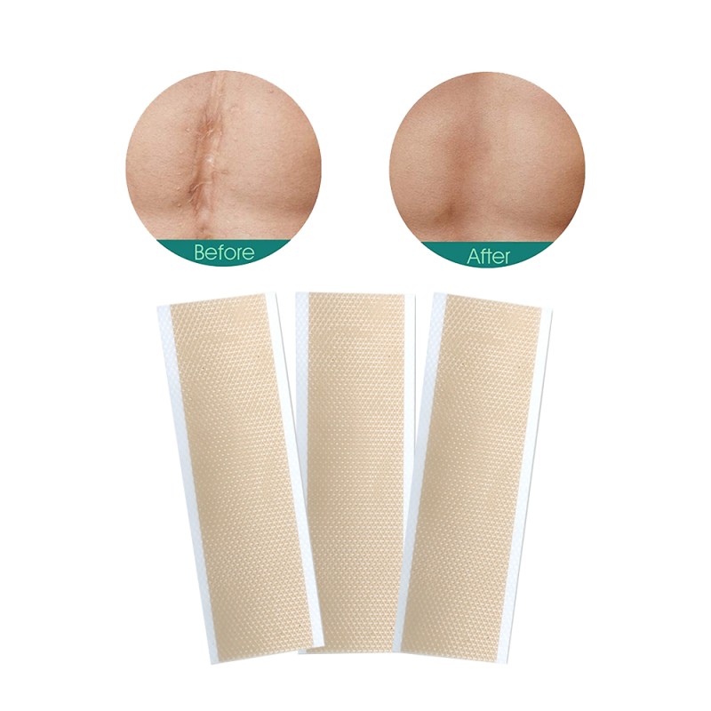 Scar Remover Patch Factory - Silicone Gel Healthcare Supply