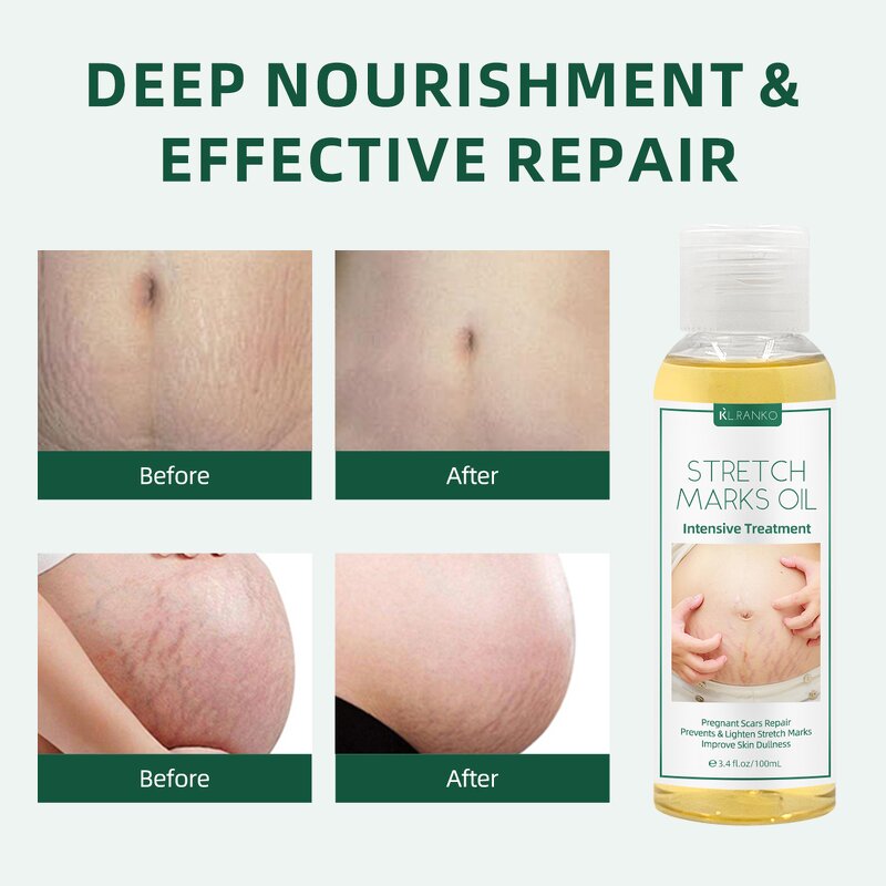 Stretch Mark Oil Manufacturer - Postpartum Repair Massage Oil - Scar Removal Body Moisturizing Treatment