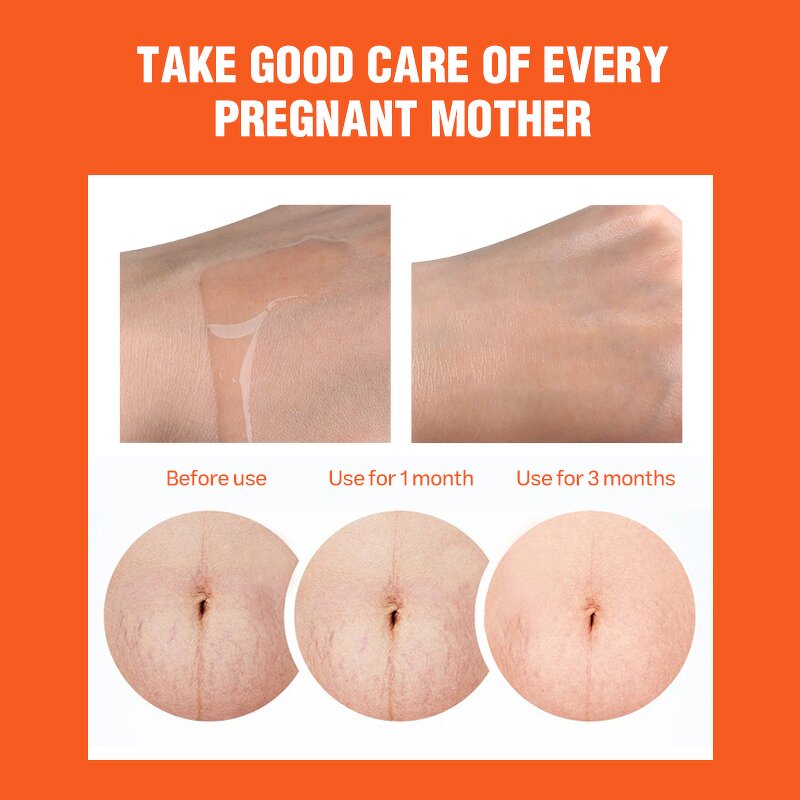 Stretch Mark Oil Manufacturer - 100% Natural Scar Removal - Safe Effective Stretch Mark Treatment Private Label