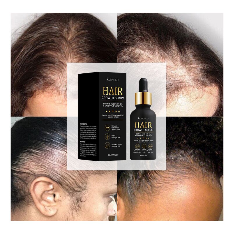 Hair Growth Oil Kit Manufacturer - Biotin Rosemary Castor Argan Batana - Thicker Fuller Hair Women OEM