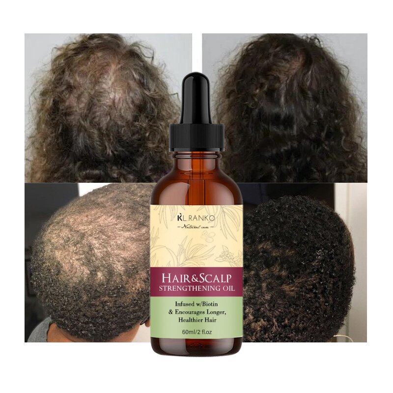 Scalp Oil Manufacturer - Rosemary Mint Biotin - Strengthening Nourishing Hair Growth Serum Private Label OEM