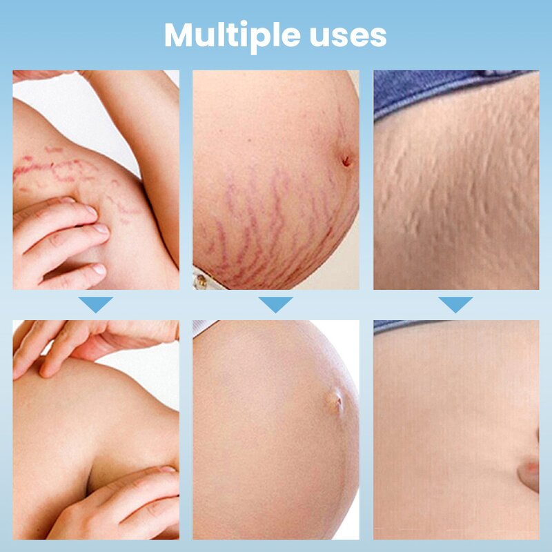 Stretch Mark Cream Manufacturer - Private Label Natural Non-Irritating Fast Acting Smooth Skin Repair Formula