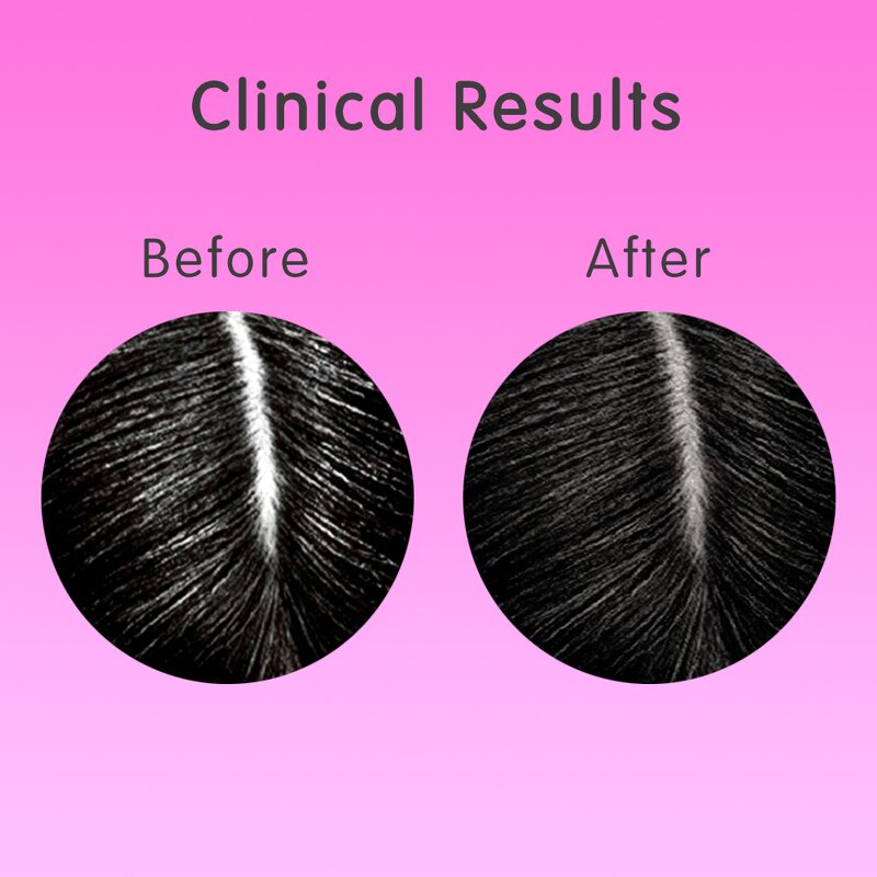 Hair Growth Oil Manufacturer - Private Label Advanced Anti-Hair Loss Fast Regrowth Hair Growth Serum