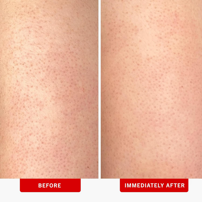 Body Scrub Manufacturer - OEM KP Bump Eraser with 10% AHA for Keratosis Pilaris Exfoliation Glycolic Lactic Acids