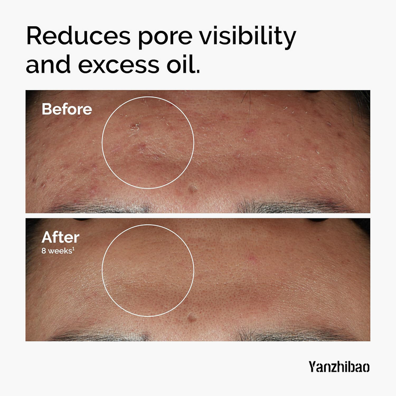 Face Serum Manufacturer - 10% Niacinamide + 1% Zinc for Blemish-Prone Skin Oil Control Pore Refining