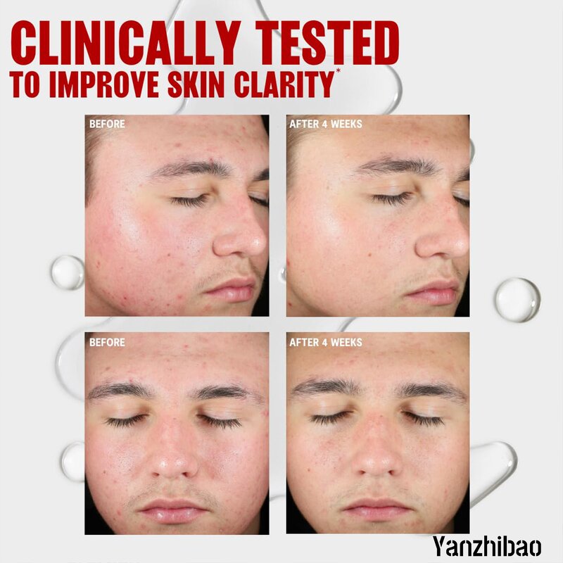 Toner Manufacturer - Blemish Clearing 2% Salicylic Acid for Acne Treatment Non-Stripping Soothing Skin Care