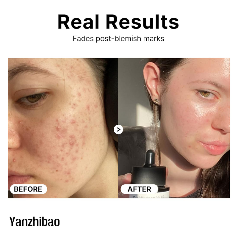 Face Serum Manufacturer - Niacinamide 15% 0.67 Fl.oz Vitamin Whitening for Pores Redness Relief