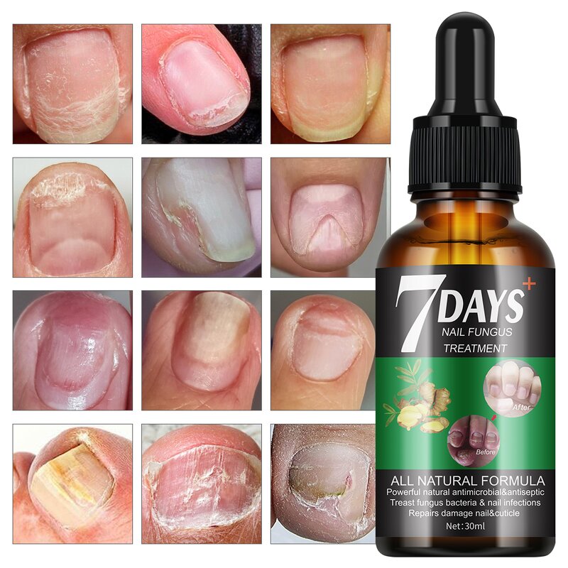 Nail Treatment Serum Manufacturer - 7 Days Nail Fungus for Damage Repair 30ml New Design MOOYAM