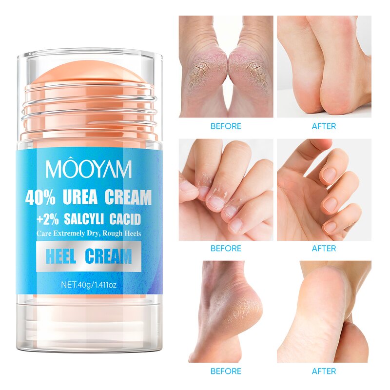 Foot Cream Manufacturer - 40% Urea+2% Salicylic Acid for Dry Rough Skin Nourishing OEM MOOYAM