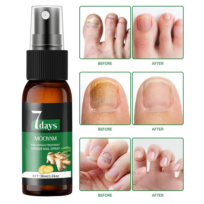 Nail Treatment Spray Manufacturer - 7 Days Nail Fungus for Bacteria Repair 30ml Customized OEM MOOYAM