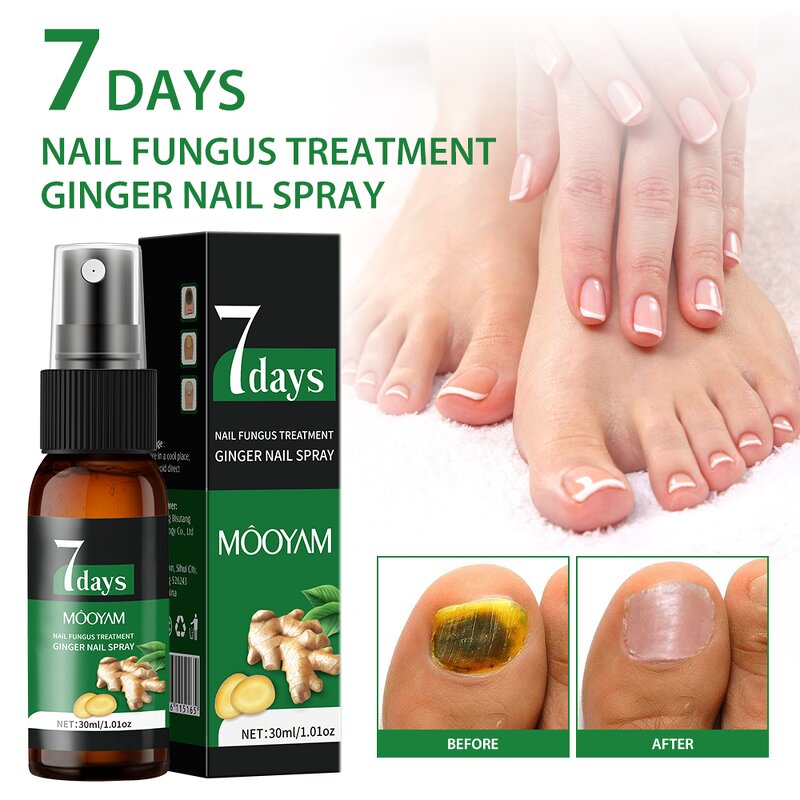 Nail Treatment Spray Manufacturer - 7 Days Nail Fungus for Bacteria Repair 30ml Customized OEM MOOYAM