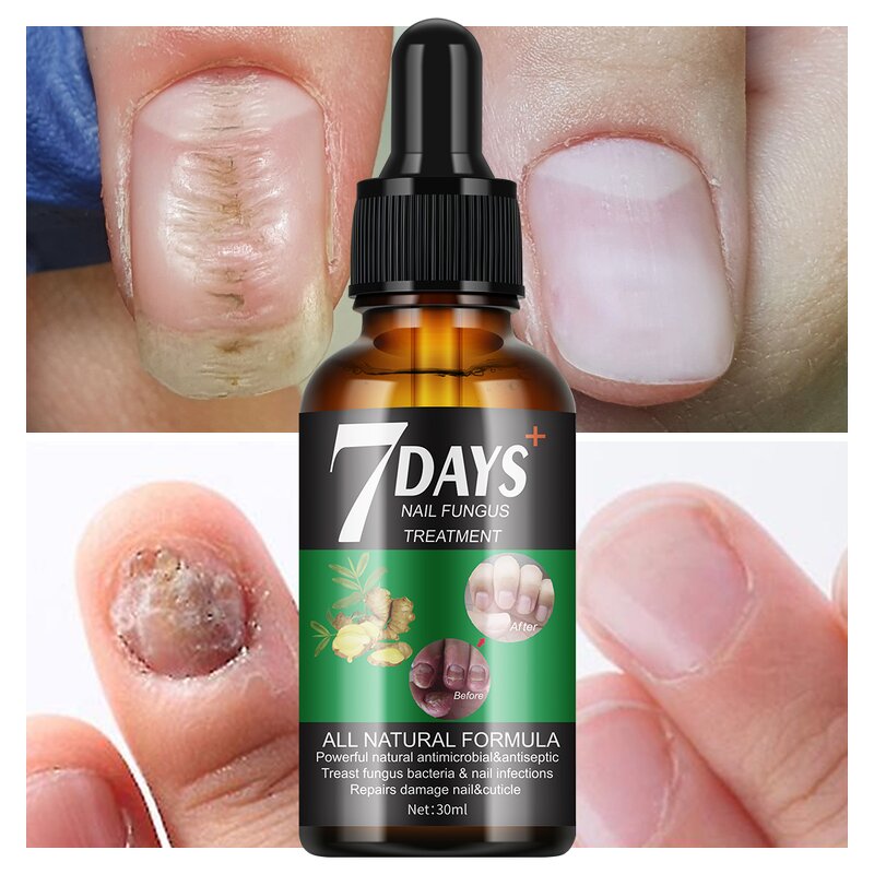 Nail Treatment Serum Manufacturer - 7 Days Nail Fungus for Damage Repair 30ml New Design MOOYAM
