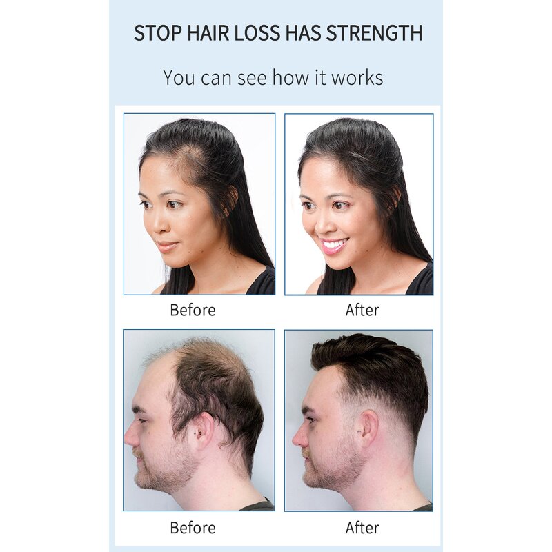 Hair Tonic Lotion Manufacturer - Organic Chinese - Rosemary Oil Essence Serum, Nourishing, Helps Grow Bald Hair Fast